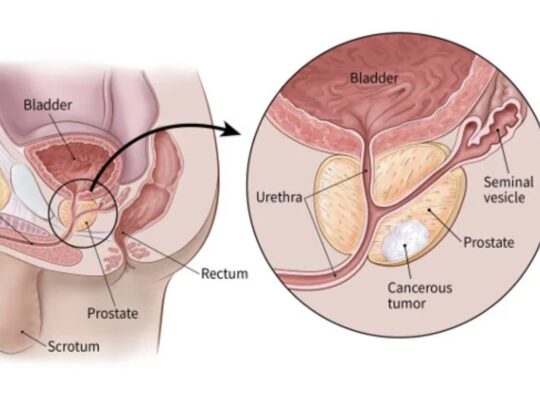 diagram showing cancers cell in Prostate